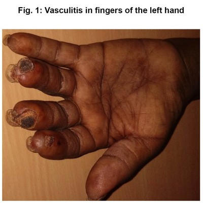 Vasculitis in fingers of the left hand